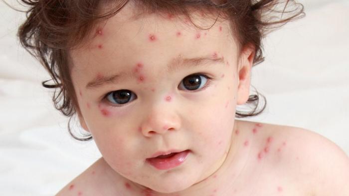 Penyebab dan Penanganan Ciri Alergi Protein pada Balita